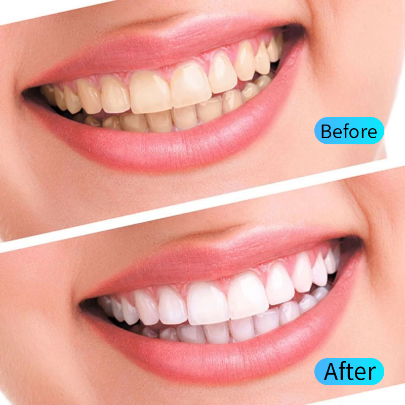 Teeth Whitening Gel Kit Oral H - Teeth Whitening Gel Refills recension och pris