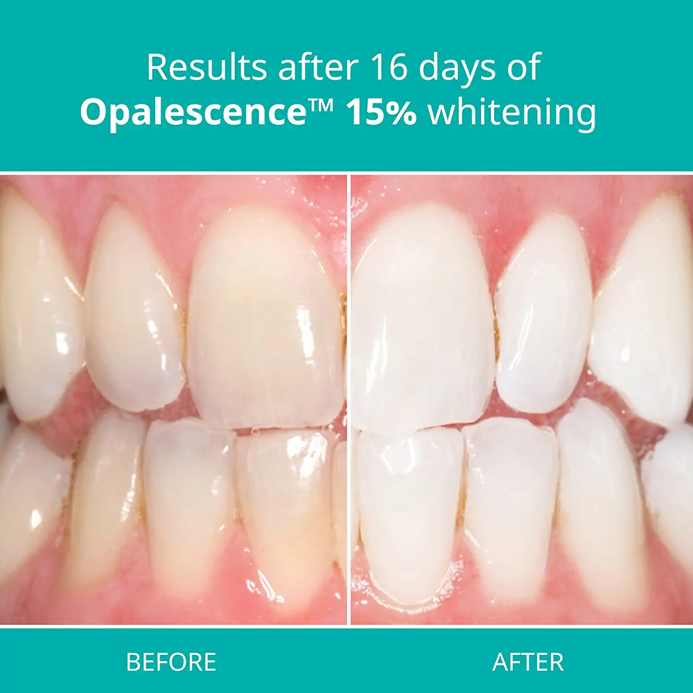 Opalescence Professional White - Teeth Whitening Gel Opalescence recension och pris