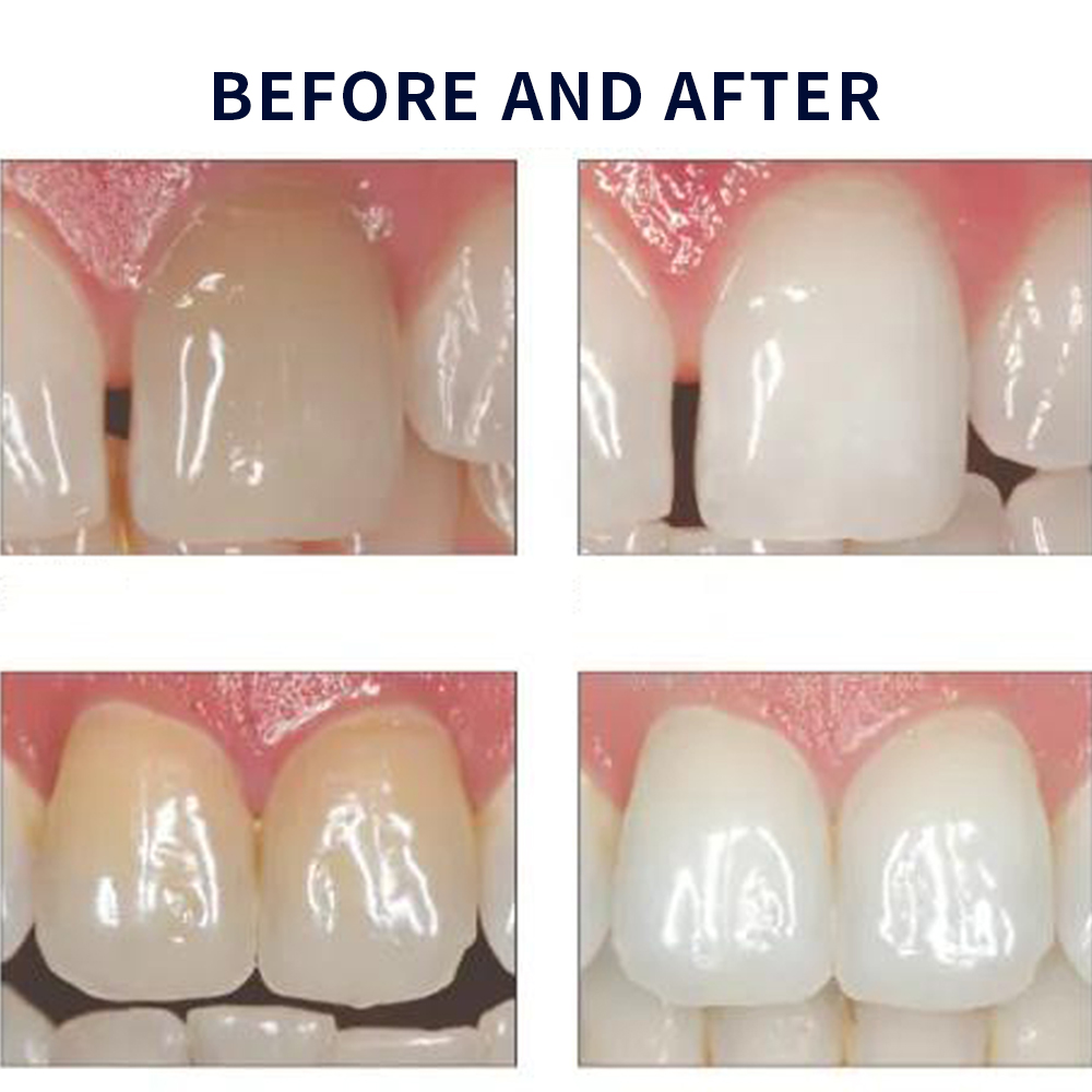 Opalescence Whitening 20% PF 2 - Teeth Whitening In Office recension och pris