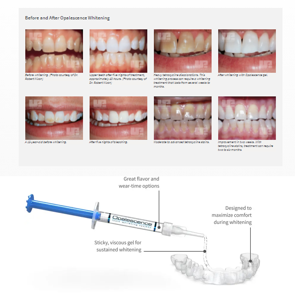 Opalescence Whitening 20% PF 2 - Teeth Whitening In Office recension och pris