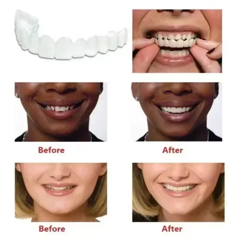 Teeth Veneers Whitening Dentur - Teeth Whitening Vape recension och pris