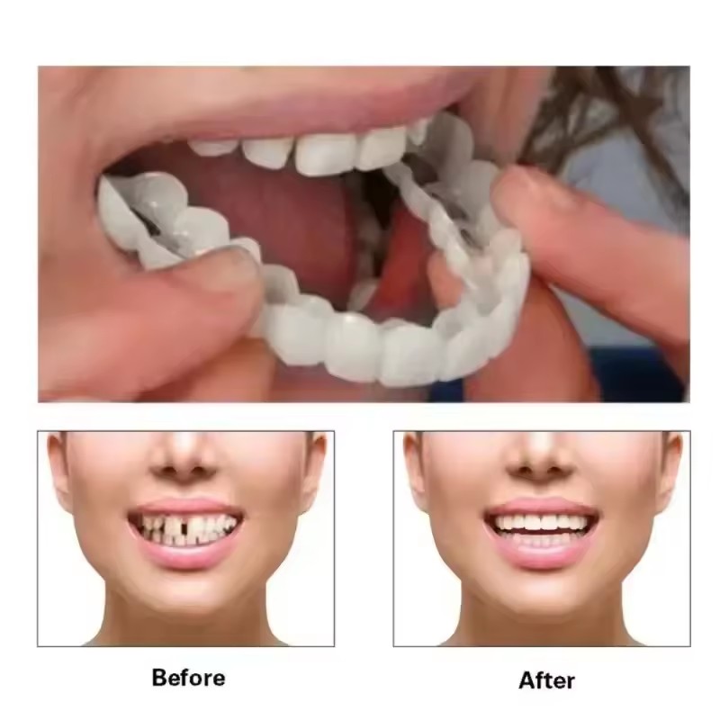 Teeth Veneers Whitening Dentur - Teeth Whitening Vape recension och pris